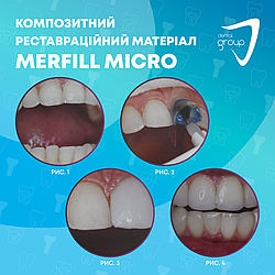 Клінічна ситуація використання композиту Merfill Micro.