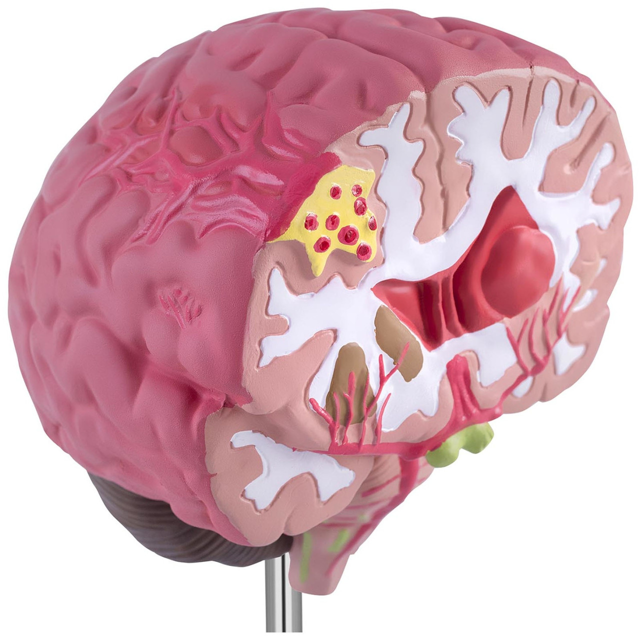 Анатомическая 3D модель головного мозга человека с 3 патологиями в ...