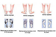 Причини та профілактика плоскостопості у дітей