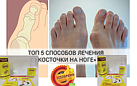 Шишка STOP крем от шишек на больших пальцах ног, Натоптиші лікування