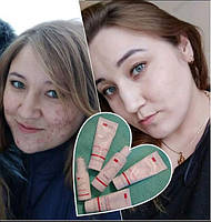 YoUnique_Чиста шкіра