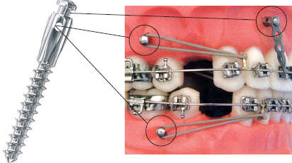 Міні-імплант ортодонтичний
