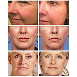 Медичний обличчя Крем з ретинолом проти старіння шкіри, зморшок, зволожуючий догляд за шкірою обличчя 20г, фото 6