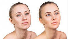 Догляд за проблемною шкірою обличчя
