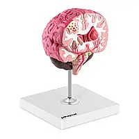 Мозг - анатомическая модель - 3 патологии physa EX10040327 Анатомические модели Германия