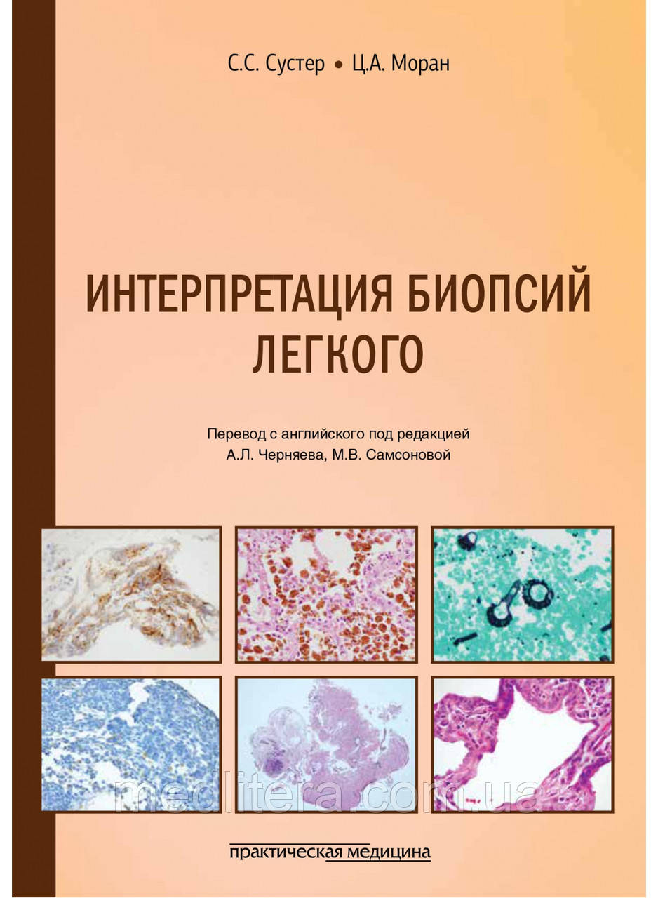 Сустер. Інтерпретація біопсій легкого