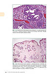 Хусейн. Інтерпретація біопсій у педіатрії, фото 8