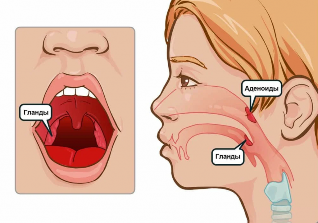 Лечение аденоидов без операции
