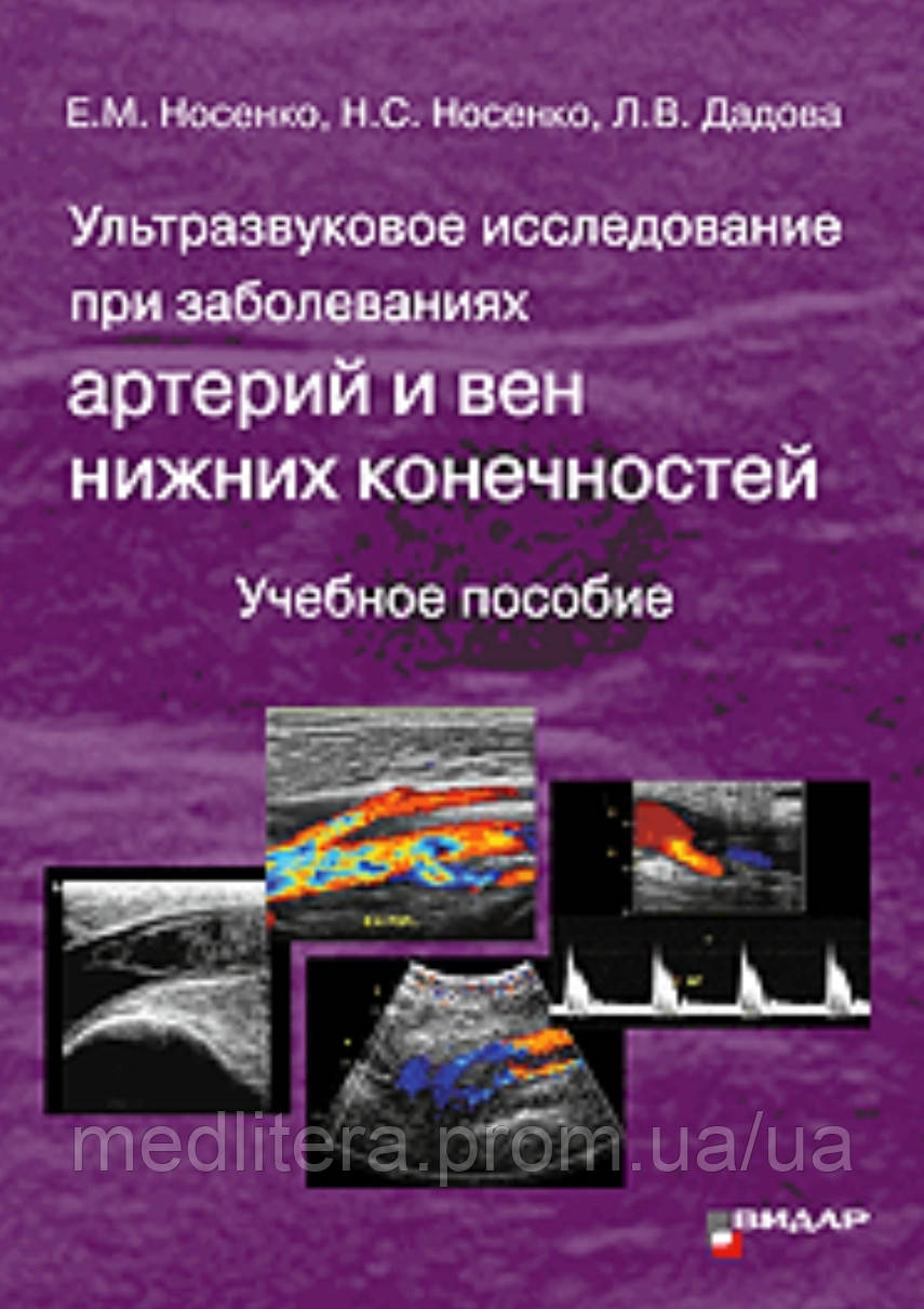 Ультразвукове дослідження при захворюваны артерій і вен нижніх кінцівок Носенко Дадова, фото 1