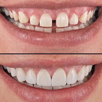 Вініри Perfect Smile Veneers (White)