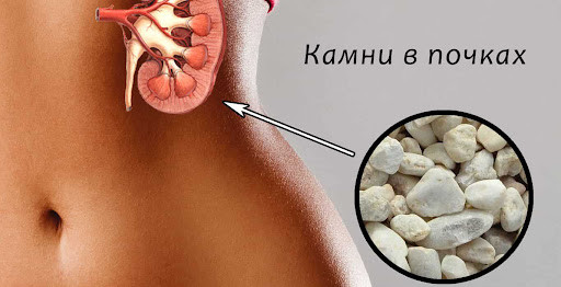 Особистий досвід: Як позбутися кіст і каменів у нирках без операції. Kidnysteen (Кідністін) - краплі для нирок
