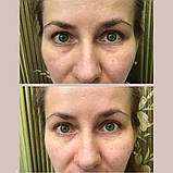 Патчі для зменшення темних кіл та набряків під очима, фото 7