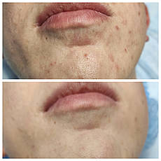 Лазерне омолодження