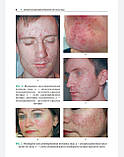 Раводін Р.А., Розтавський К.І. Акнеформні дерматози й акне в практиці лікаря-дерматовенеролога. Інструкція, фото 5