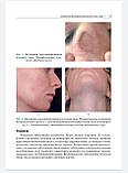 Раводін Р.А., Розтавський К.І. Акнеформні дерматози й акне в практиці лікаря-дерматовенеролога. Інструкція, фото 6