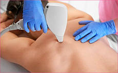 Лазерна епіляція спини (чоловіки)