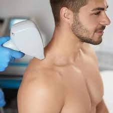 Лазерна епіляція плечей (чоловіки)