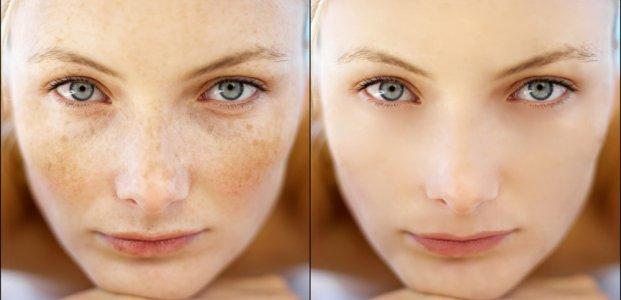 Лазерне лікування пігментних плям, фото 1