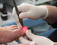 Лазерное лечение онихомикоза (грибковое поражение ногтевой пластины)