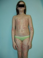 У разі псоріазу