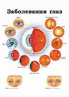 Заболевания глаз - постер
