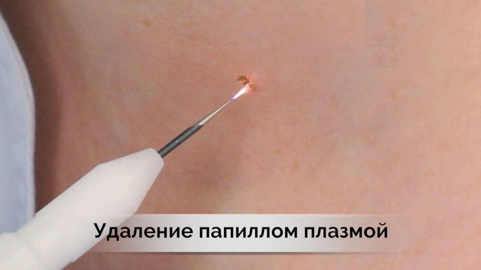 Электрокоагулятор, коагулятор для удаления папиллом и бородавок D-02 ...