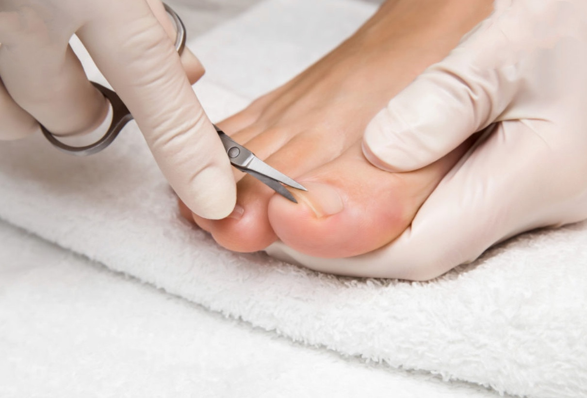 Вирізання врослого нігтя, фото 1