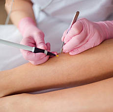 Електроепіляція 1 хвилина