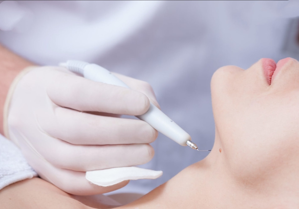 Лазерне видалення папілом, фото 1