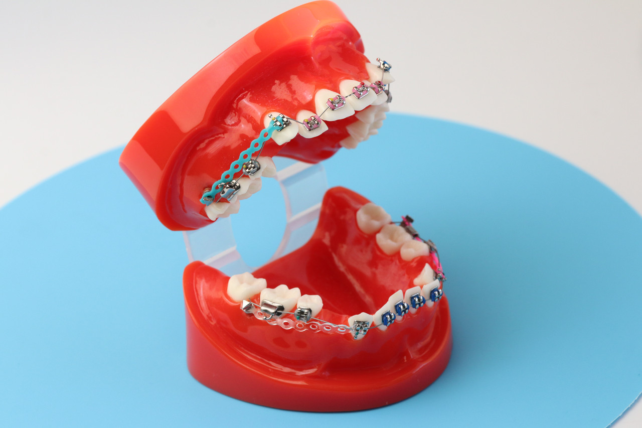 Стоматологічна модель з брекетами та патологіями