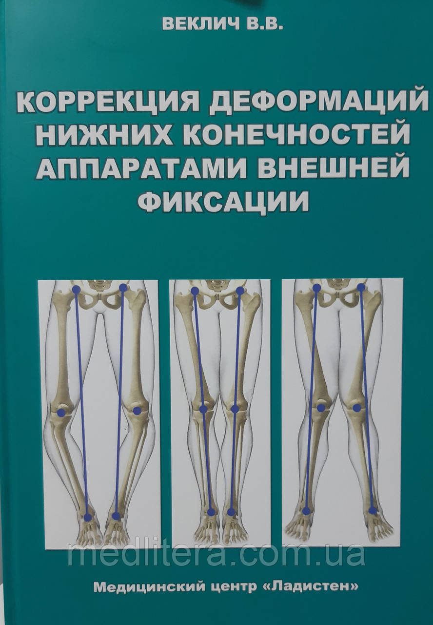 Веклич. Корекція деформацій нижніх кінцівок апаратами зовнішньої фіксації
