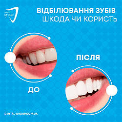 Відбілювання зубів. Шкода чи користь