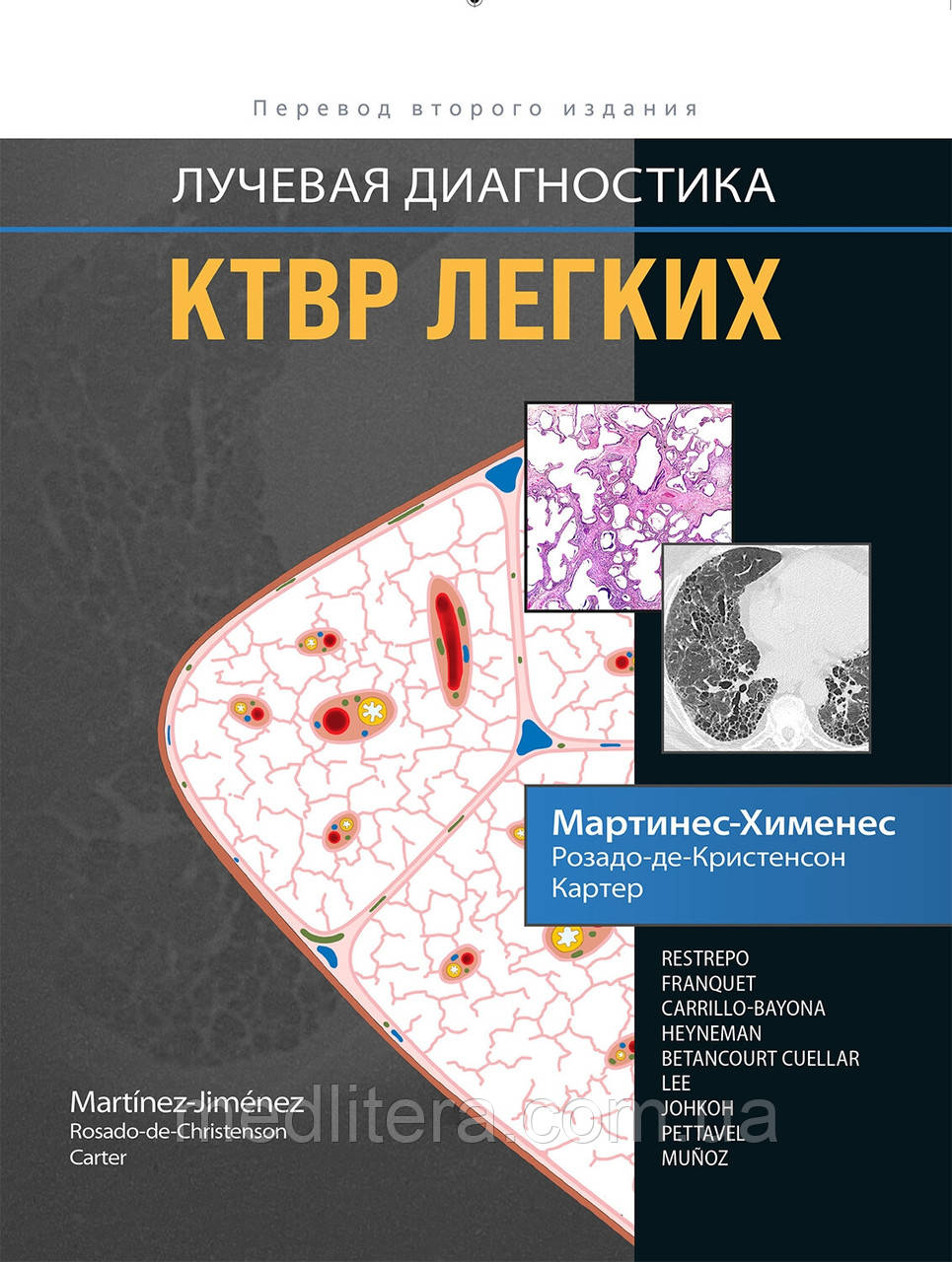 Мартінес-Хіменес, М. Л. Троянда-де-Крістенсон, Б. В. Картер. Променева діагностика. КТВР легень