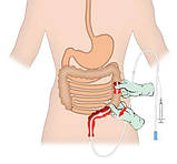 Зонд інтубаційної для дренування кишечника трансректальне довжиною 2600 мм., фото 4