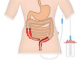 Зонд інтубаційної для дренування кишечника трансректальне довжиною 2600 мм., фото 3