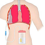 Подовжувач дренажу по Бюллау, фото 3