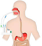 Зонд для ентерального харчування (з зондом - пілотом)., фото 4