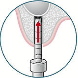 Остеотом з кольоровим кодуванням для синус-ліфтингу, увігнутий, прямий, діаметр 5,0 мм, Medesy 1322/5, фото 2