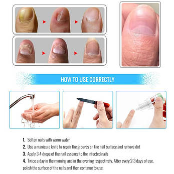 Відновлювальний крем для нігтів Omy Lady Fungal Nails Treatment, 5 мл | Limon, фото 3