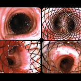 Трахеальний стент Y shape частково з покриттям, MICRO-TECH, фото 9