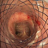 Трахеальний стент частково з покриттям, MICRO-TECH, фото 5