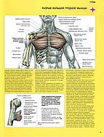 Грудь. Разрыв большой грудной мышцы - плакат