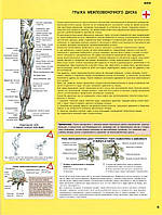 Ноги. Грижа міжхребцевого диска – плакат
