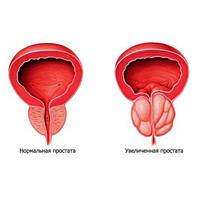 ПРОСТАТИТ