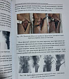 Переломи дистального відділу променевої кістки та їх наслідки. Страфун С.С., Техонце С.В., Безуглий А.А., фото 6