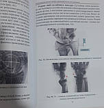 Переломи дистального відділу променевої кістки та їх наслідки. Страфун С.С., Техонце С.В., Безуглий А.А., фото 5