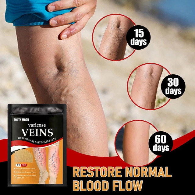 Пластырь от варикозного расширения вен, облегчение боли в ногах, отек, пластырь с дождевым червем