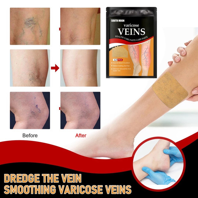 Пластырь от варикозного расширения вен, облегчение боли в ногах, отек, пластырь с дождевым червем