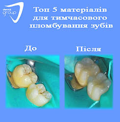 Топ 5 матеріалів для тимчасового пломбування зубів