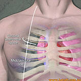 Декомпресійна голка для пневмоторкаксу декомпресійна голка арс rhino rescue, фото 4